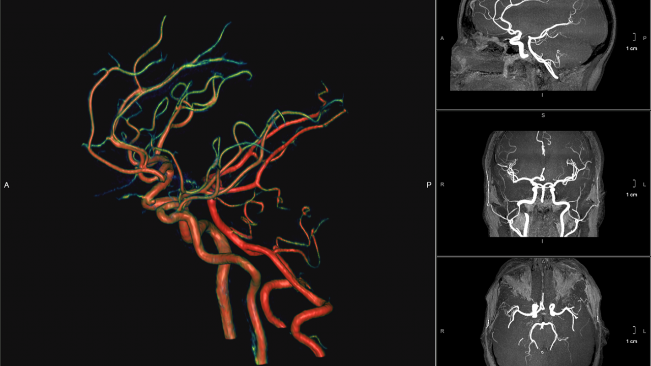 健康・医学 Interventional Neuroradiology Interventional Neuroradiology – Los Angeles, CA | Cedars-Sinai