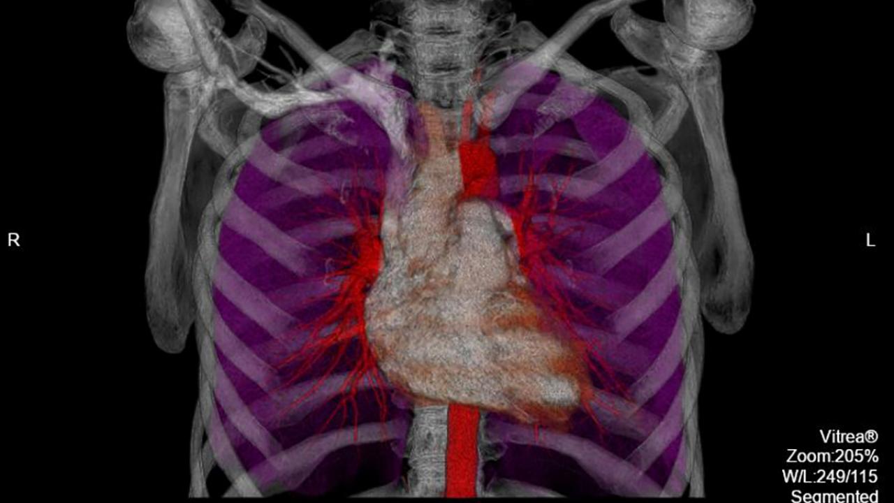 Division of Cardiothoracic Imaging Columbia Radiology Columbia