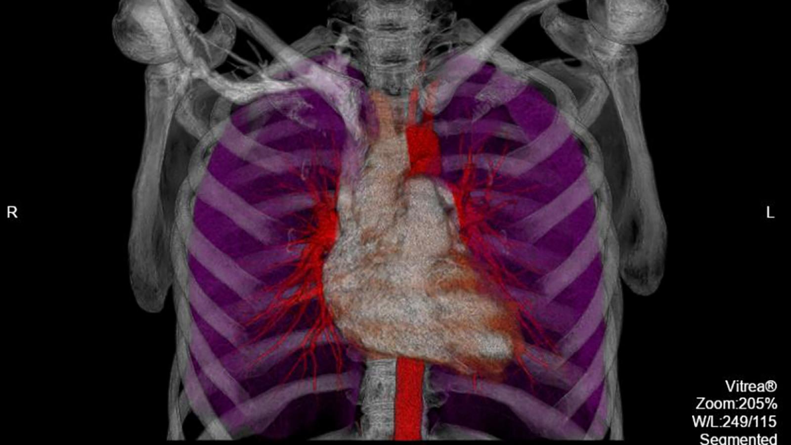 Division of Cardiothoracic Imaging Columbia Radiology Columbia Department of Radiology