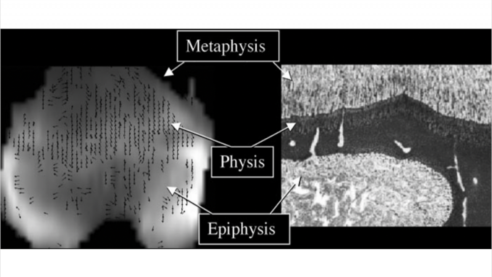 Diffusion-weighted image shows parallel distal femoral tracts in the physis and proximal metaphysis of a 3-week-old piglet