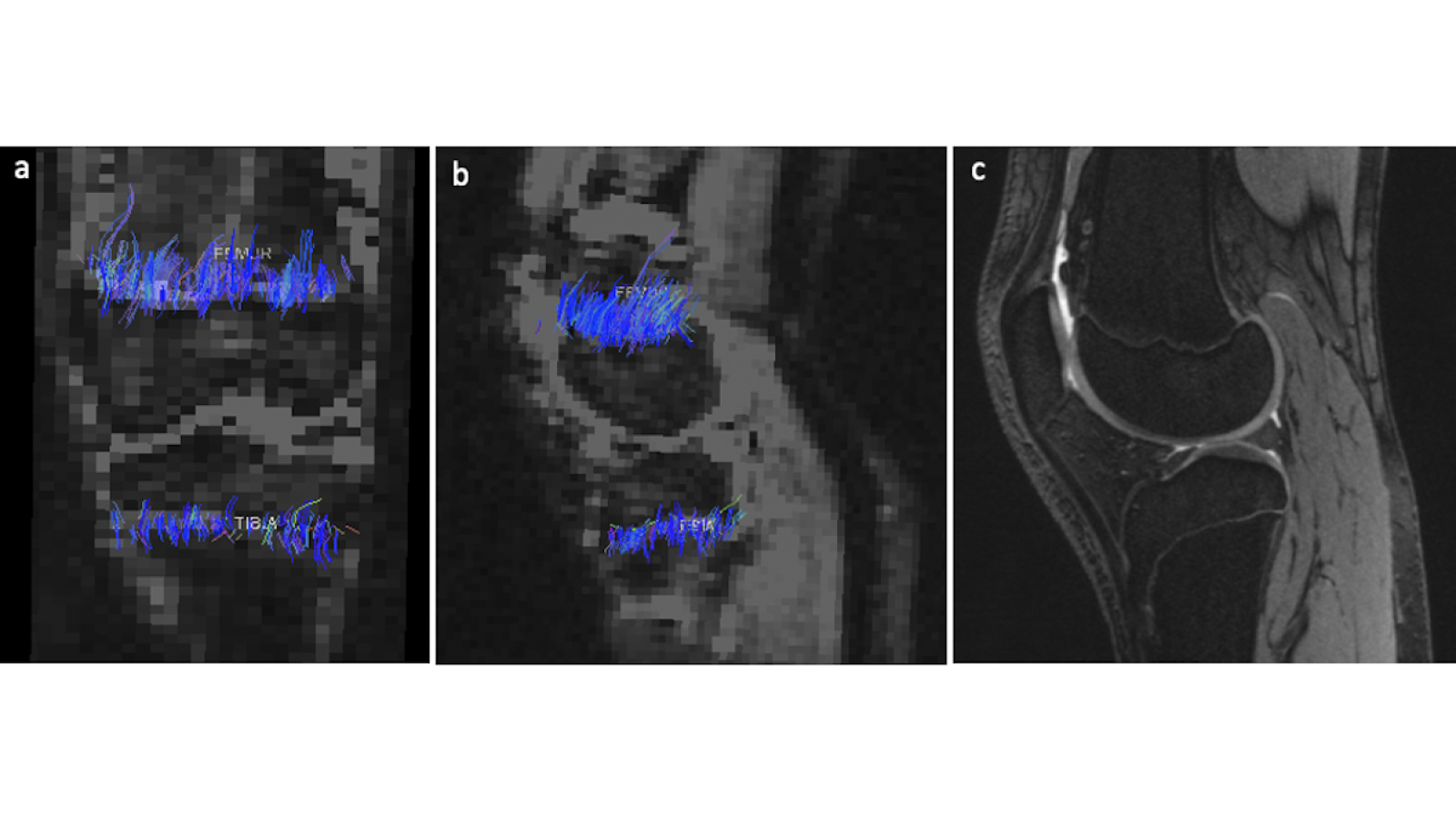Diffusion tensor imaging images showing growth plate in 13 year old girl