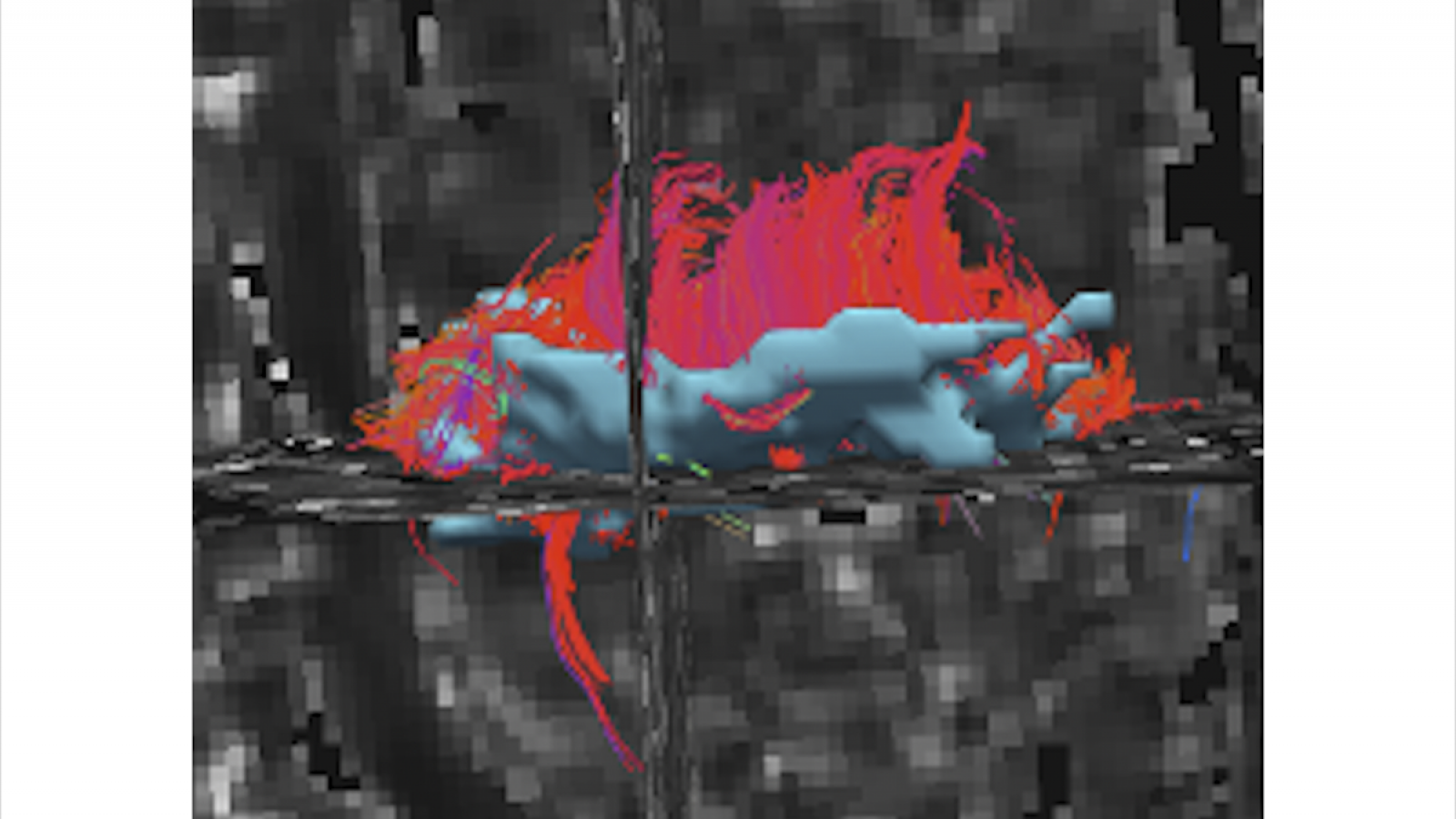 Diffusion tensor imaging showing Sagittal tractography on a 12-year-old boy