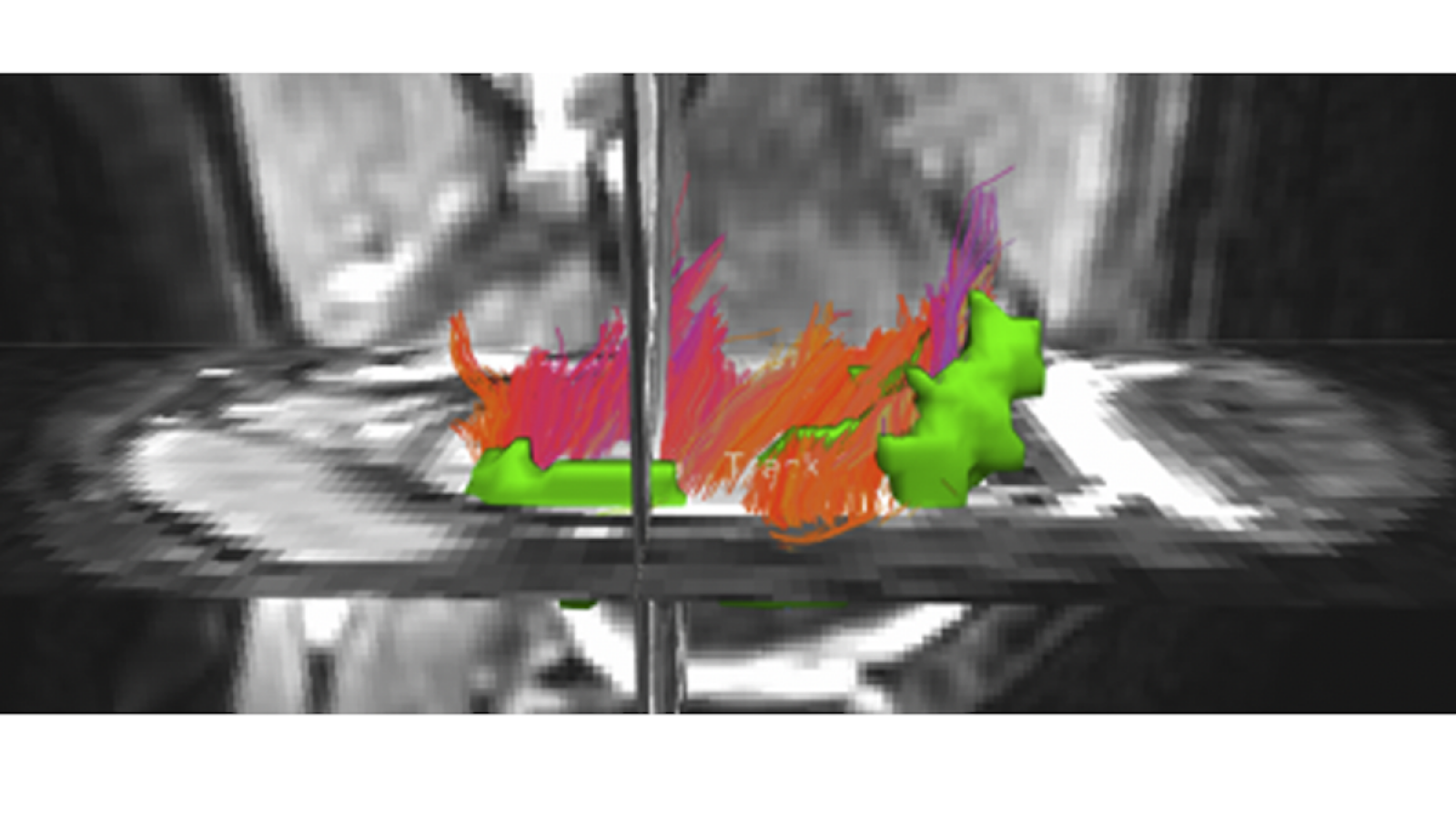 Sagittal tractography on a 12-year-old boy, viewed from above