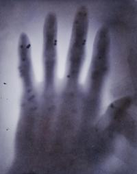 Early Xray of a hand showing bullets