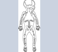 Drawing of infant skeleton with fractures