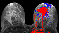 Bilateral Breast Imaging Scan