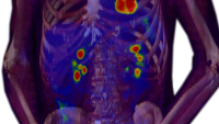 Nuclear medicine scan of torso