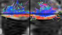Diffusion tensor imaging of the growth plate.