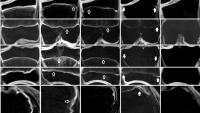 Each row is 1 of 5 growth plates studied. Columns represent a different stage of closure in study population. Open arrows in 4a and 4b indicate areas where bone bridging is present. Solid arrows in 4c indicate areas where growth plate is still unfused.