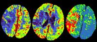 CT perfusion images of a stroke