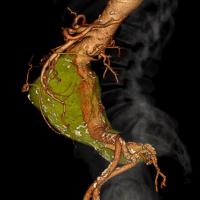 3D image of an aneurysm